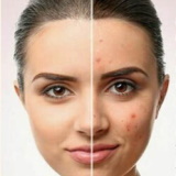 Acne IV